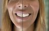 Wellys Set zur Zahnaufhellung